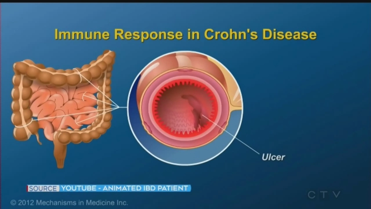 The Connection between Chronic Diarrhea and Inflammatory Bowel Disease (IBD)