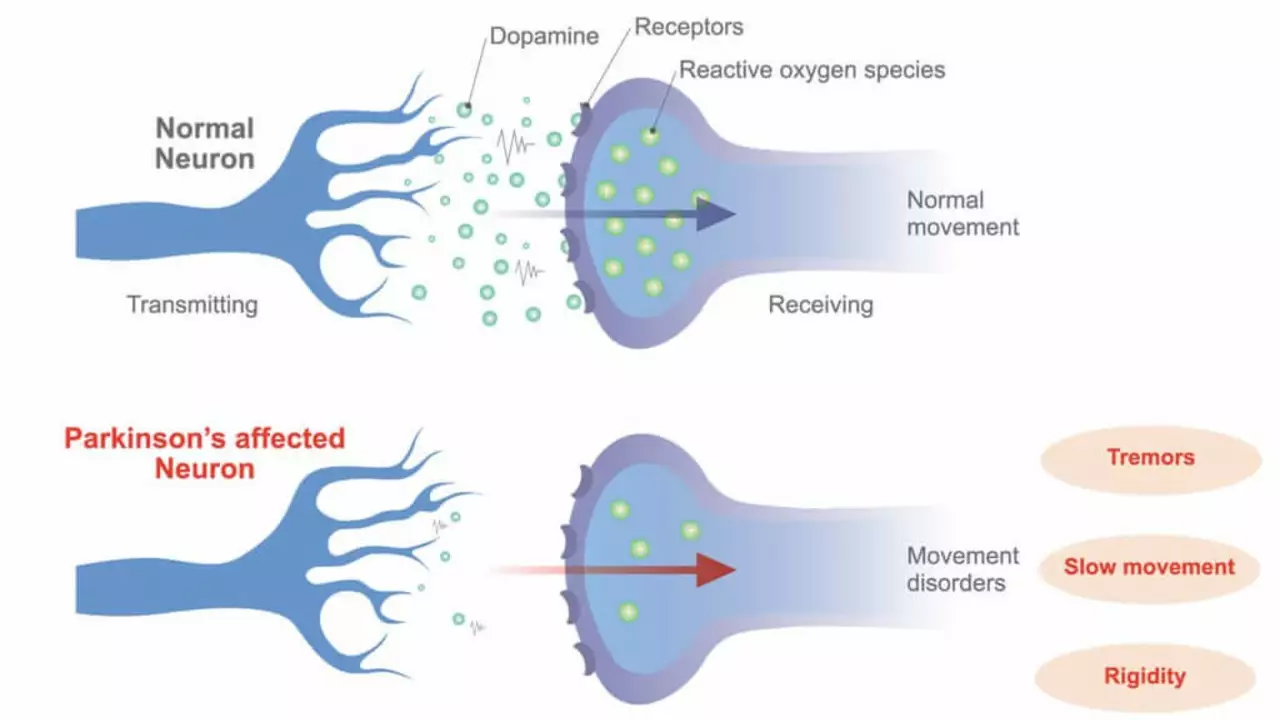 The Role of Rasagiline in Slowing Parkinson's Disease Progression